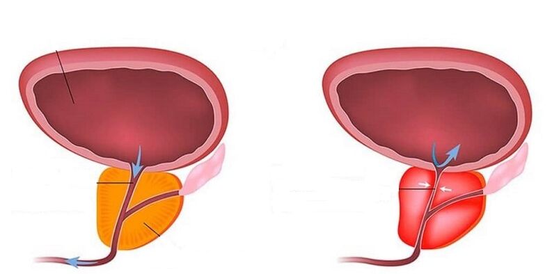 Zdrowa i zapalna prostata z zapaleniem prostaty