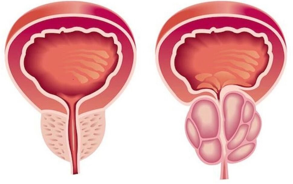 zdrowa i zapalona prostata z zapaleniem prostaty